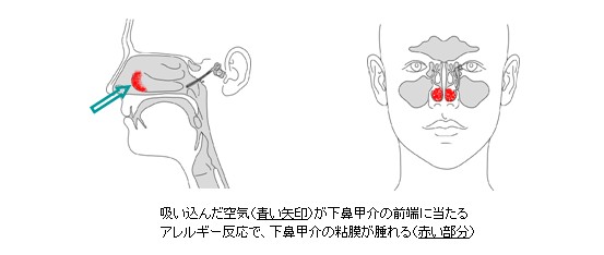 アレルギー性鼻炎